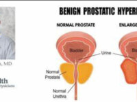 Natural remedies for enlarged prostate (BPH)