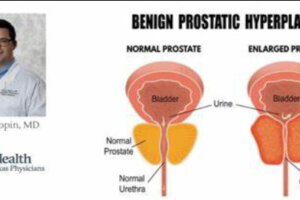 Natural remedies for enlarged prostate (BPH)