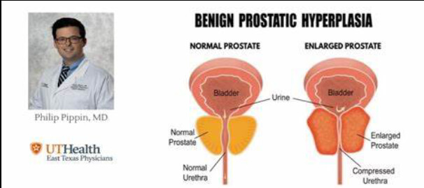 You are currently viewing Natural remedies for enlarged prostate (BPH)